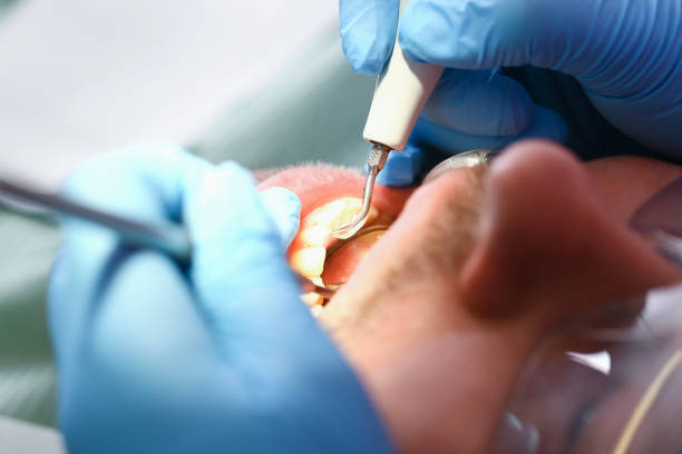 Best Emergency Wisdom Teeth Removal in Grasonville, MD
